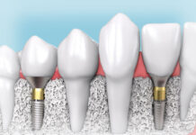 Что важно знать об имплантации зубов?